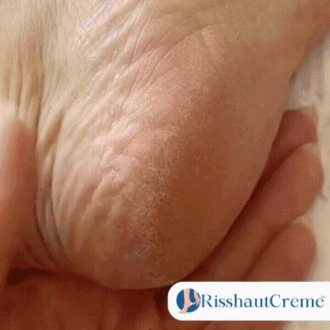 RisshautCreme™ | Creme zur Reparatur rissiger Haut