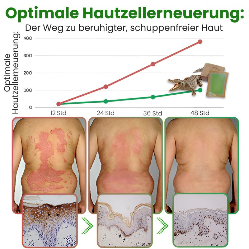 KrokoDerma™ | Krokodilöl-Seife gegen Psoriasis und Ekzeme