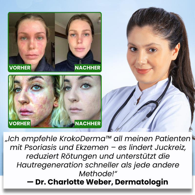 KrokoDerma™ | Krokodilöl-Seife gegen Psoriasis und Ekzeme