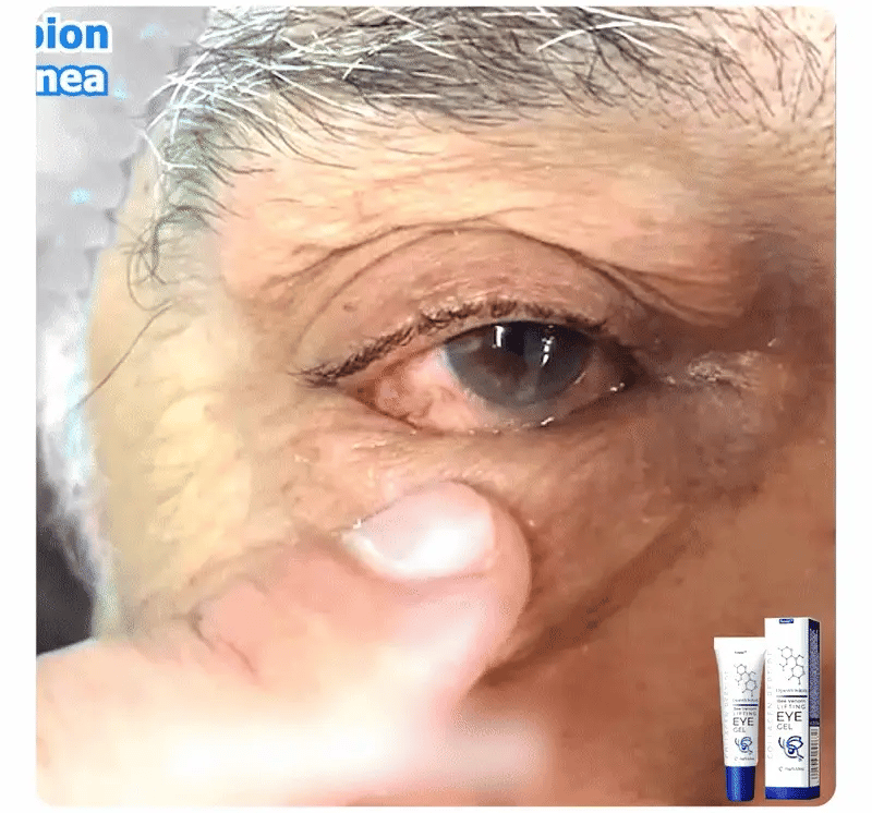 KlarVision™ | Gewinnen Sie strahlende, jugendliche Augen in nur 1 Woche zurück!