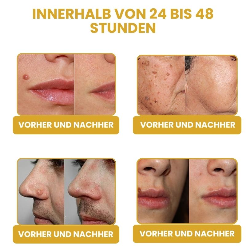 ClearZap™ | Bienengift Warzenentferner