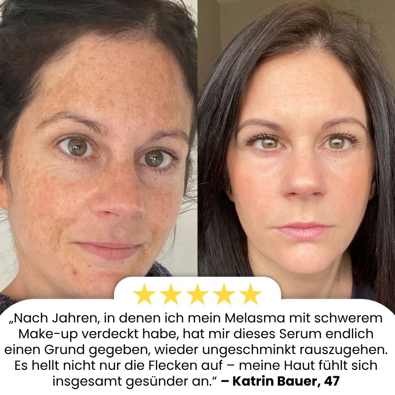 MelanoFix™ | Anti-Hyperpigmentierungsserum