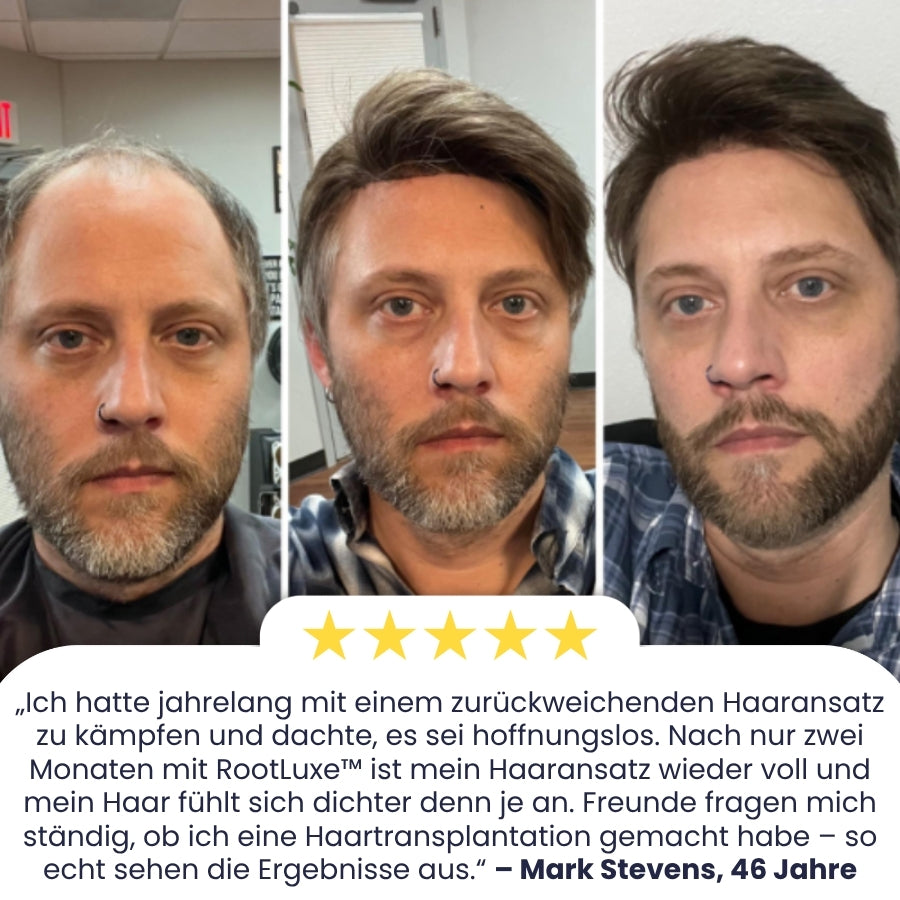 RootLuxe™ | Mikronadel-Haarwuchs-Set