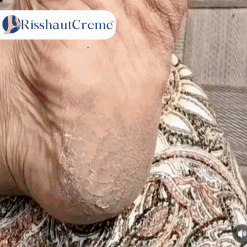 RisshautCreme™ | Creme zur Reparatur rissiger Haut