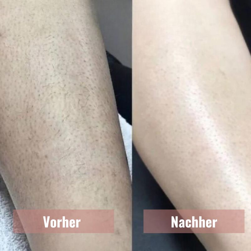 ZeroIrrit™ | Beruhigender Haut-Sicherheitsrasierer