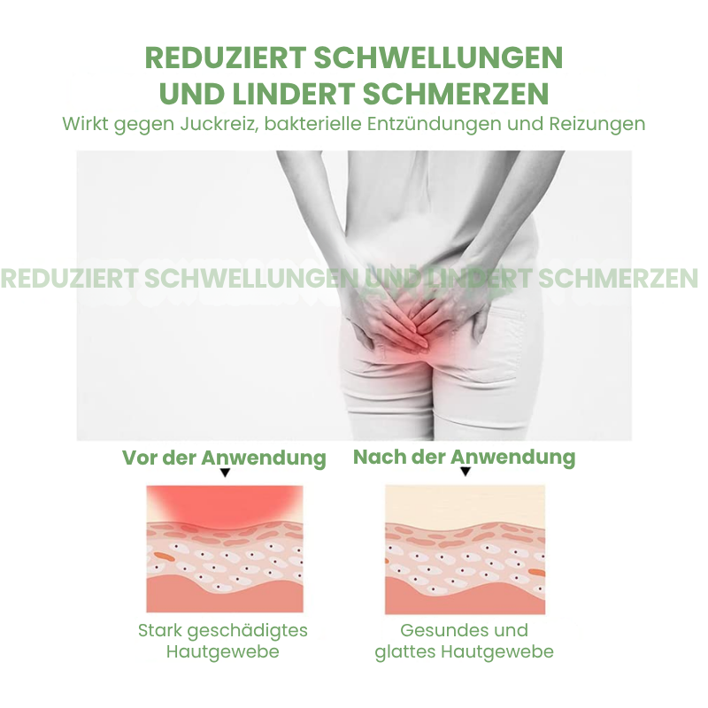 Healvix™ | Beruhigende Hämorrhoidencreme