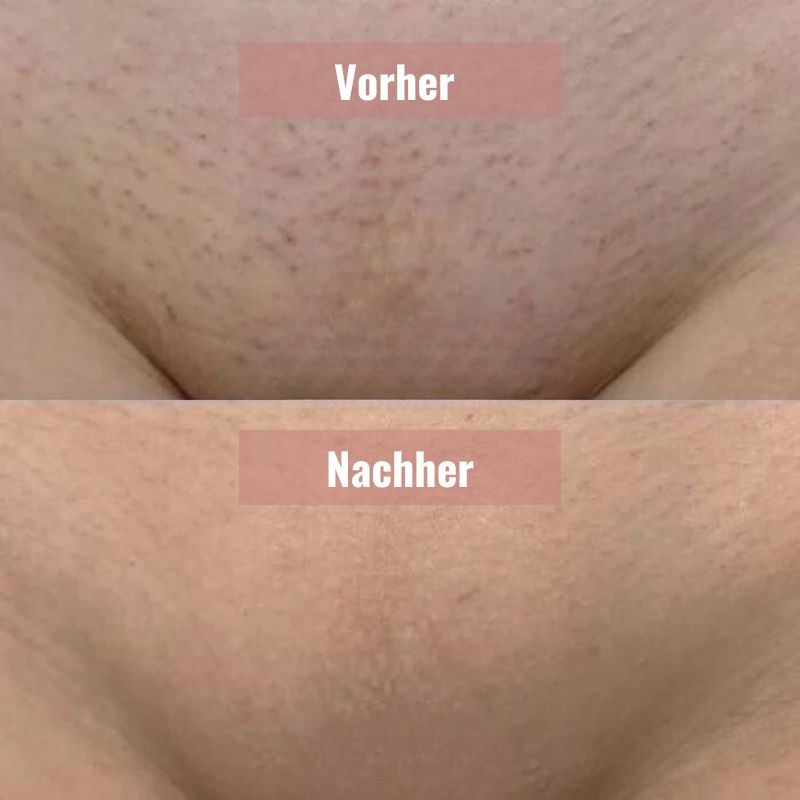 ZeroIrrit™ | Beruhigender Haut-Sicherheitsrasierer