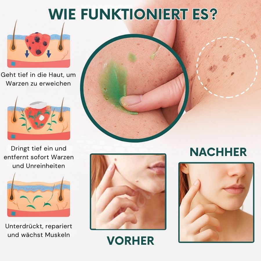 PerfekteHaut™ | Sofort-Gel zur Entfernung von Muttermalen & Flecken