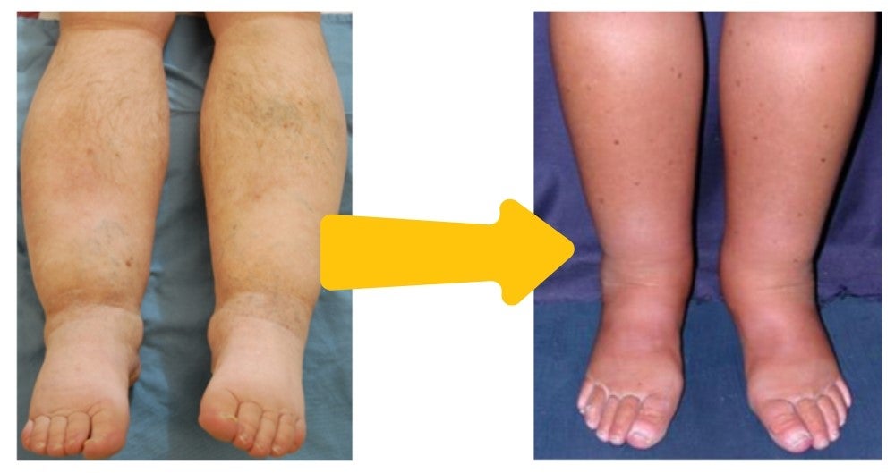 VenoFix® | Creme gegen Ödeme, Lymphödeme und Krampfadern