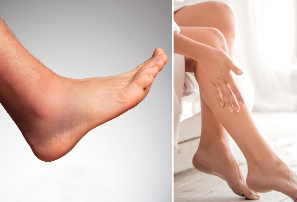 VenoFix® | Creme gegen Ödeme, Lymphödeme und Krampfadern