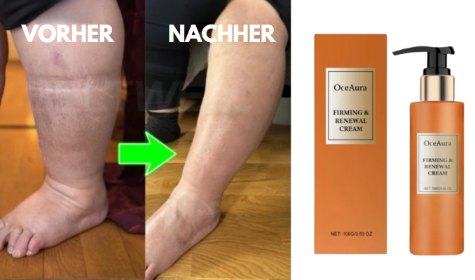 VenoFix® | Creme gegen Ödeme, Lymphödeme und Krampfadern