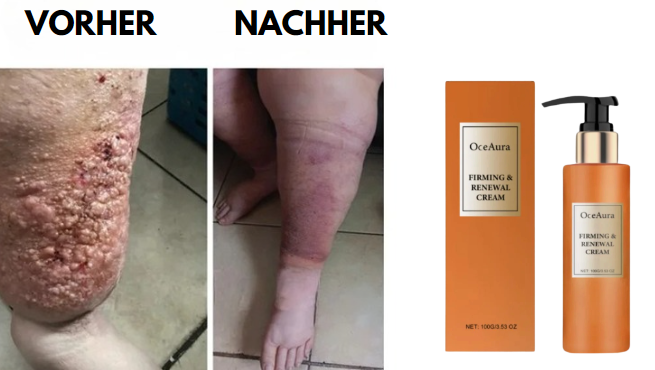 VenoFix® | Creme gegen Ödeme, Lymphödeme und Krampfadern