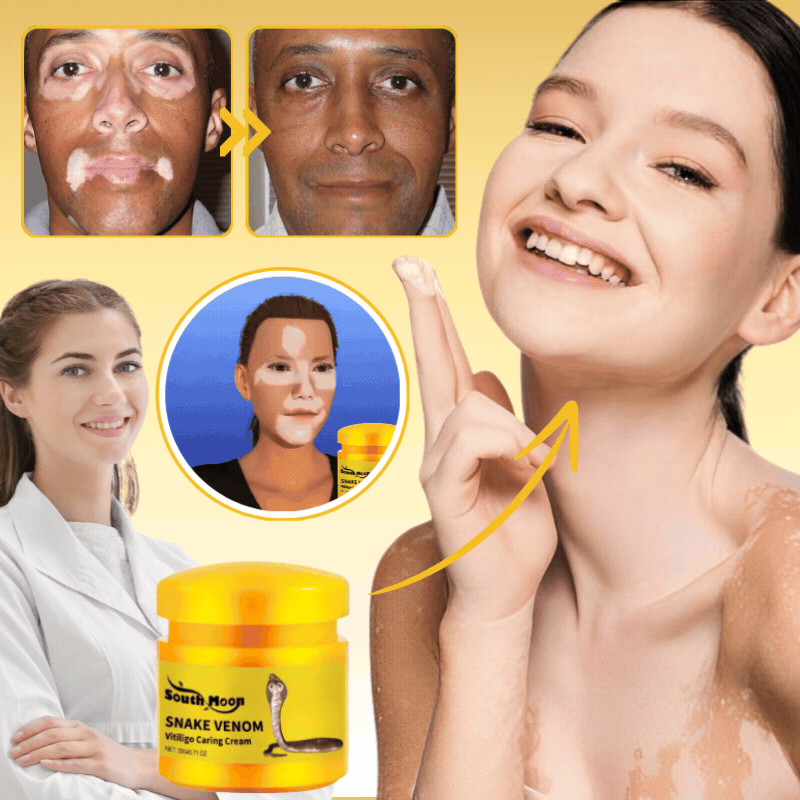 VitiligoCreme™ | Schlangengift Vitiligo Behandlungssalbe