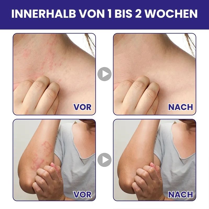 ItchOff™ | Antibakterielle Creme