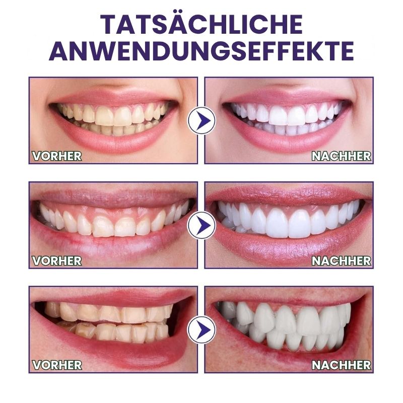 PureWhite™ | Zahnaufhellungs-Kit