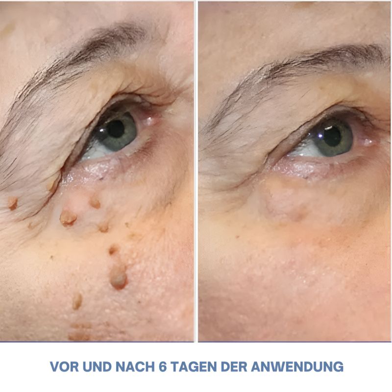 WartsOff™ | Entfernt Warzen sofort – schmerzlos