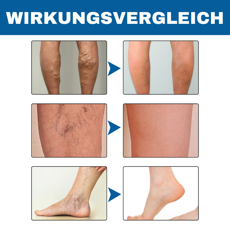 ClariVeno™ | Krampfader-Stick-Creme