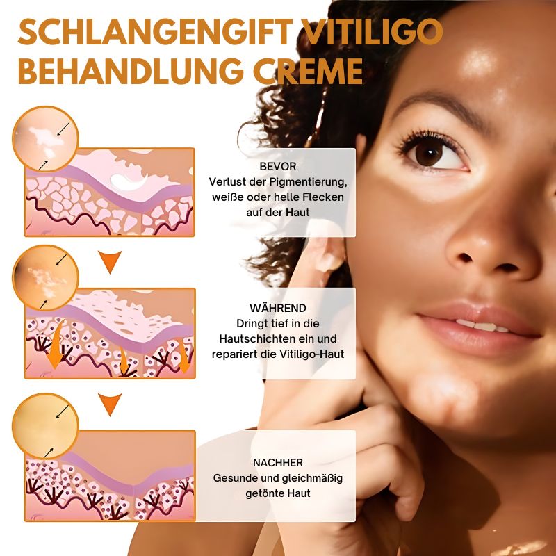 VitiligoCreme™ | Schlangengift Vitiligo Behandlungssalbe