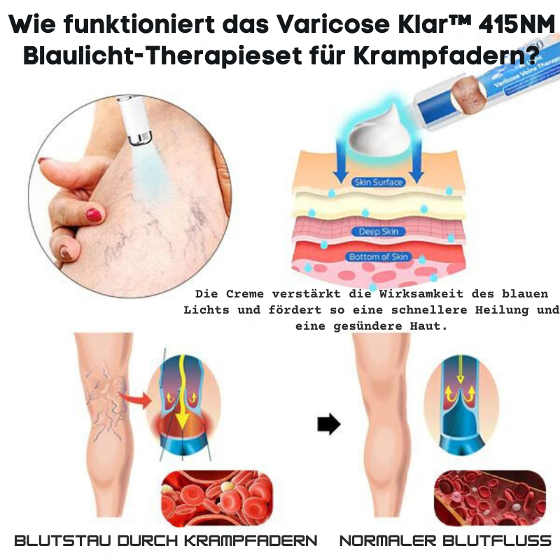 VaricoseKlar™ | Vollständige Beseitigung von Krampfadern in nur 4 Wochen!