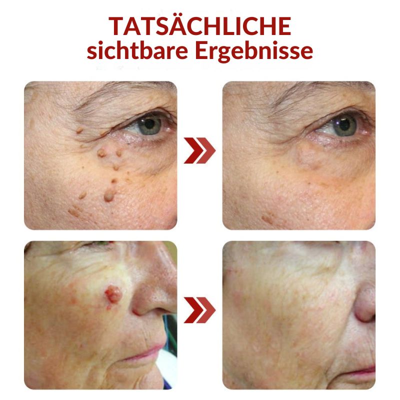 DermaFix™ | Serum-Stift zur Entfernung von Hautwucherungen und Muttermalen