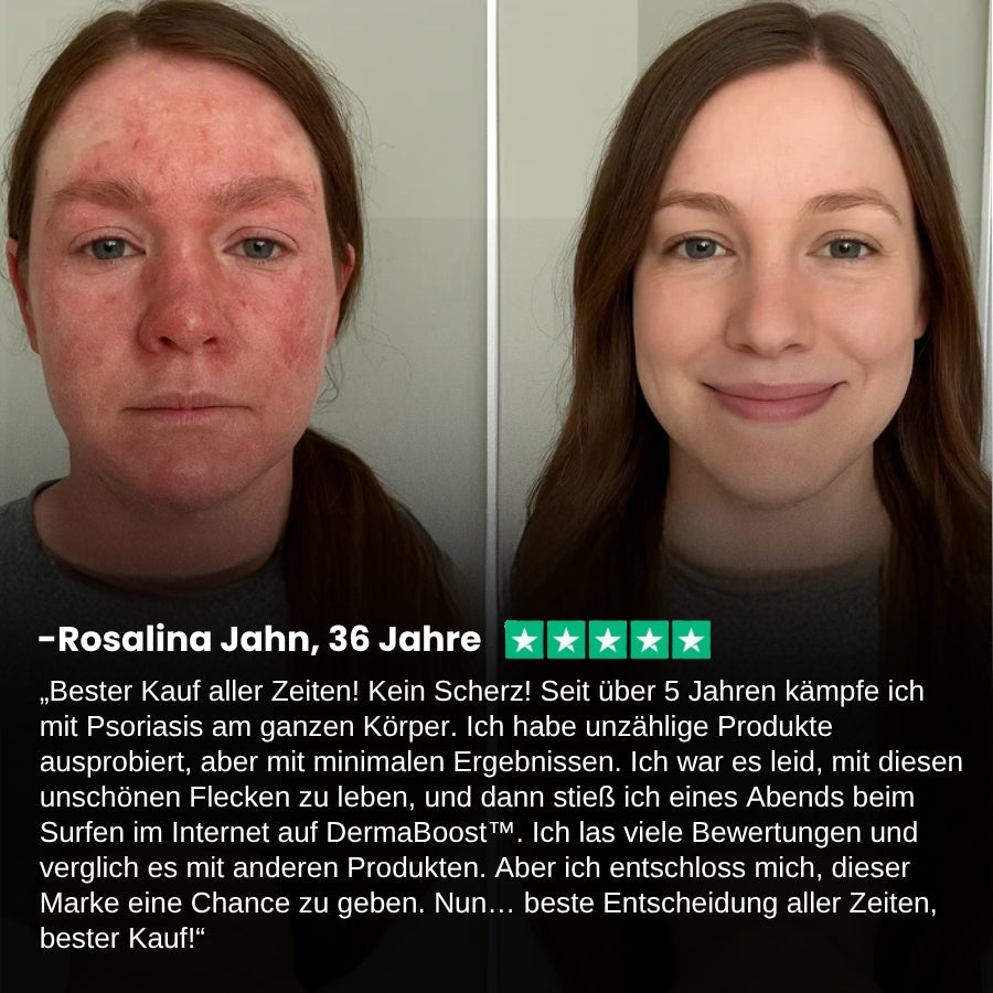 DermaBoost™ | Psoriasis und Ekzem Kräuter‑Beruhigungsspray