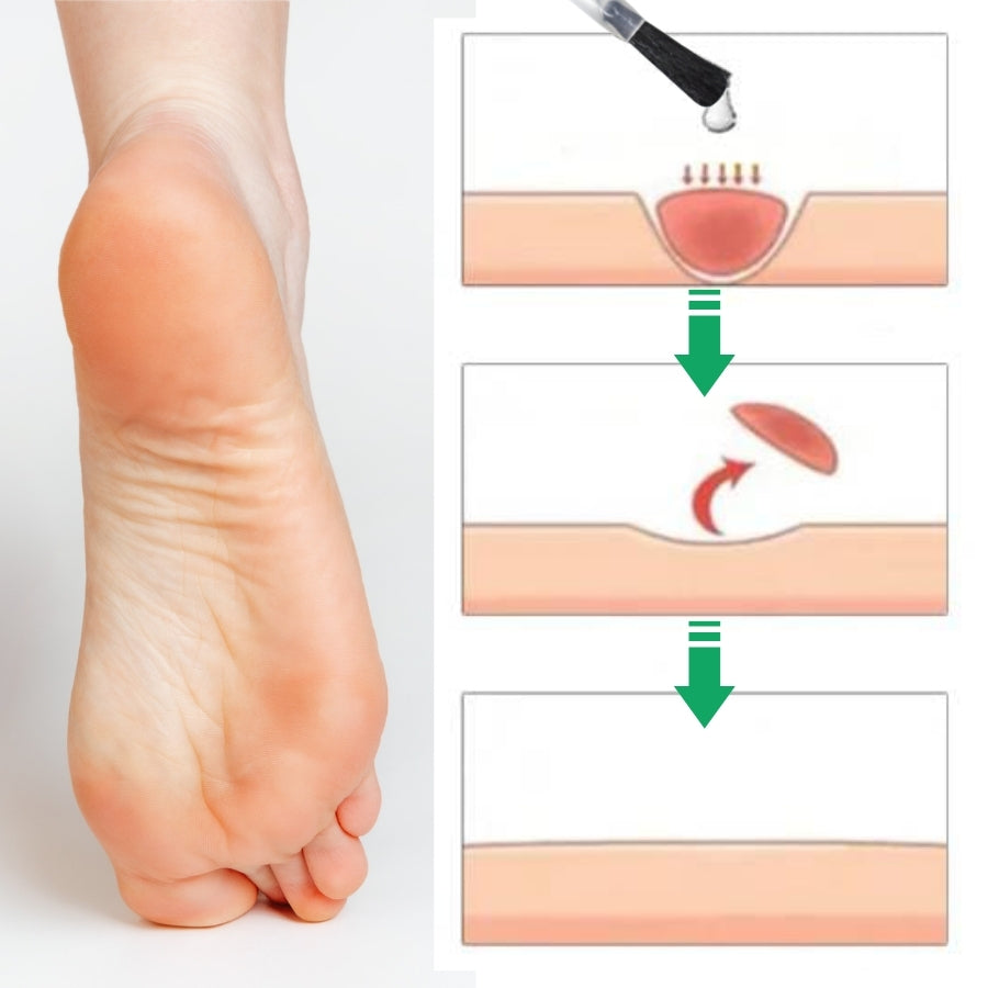 CalluFix™ | Aktives Hornhautentferner-Gel