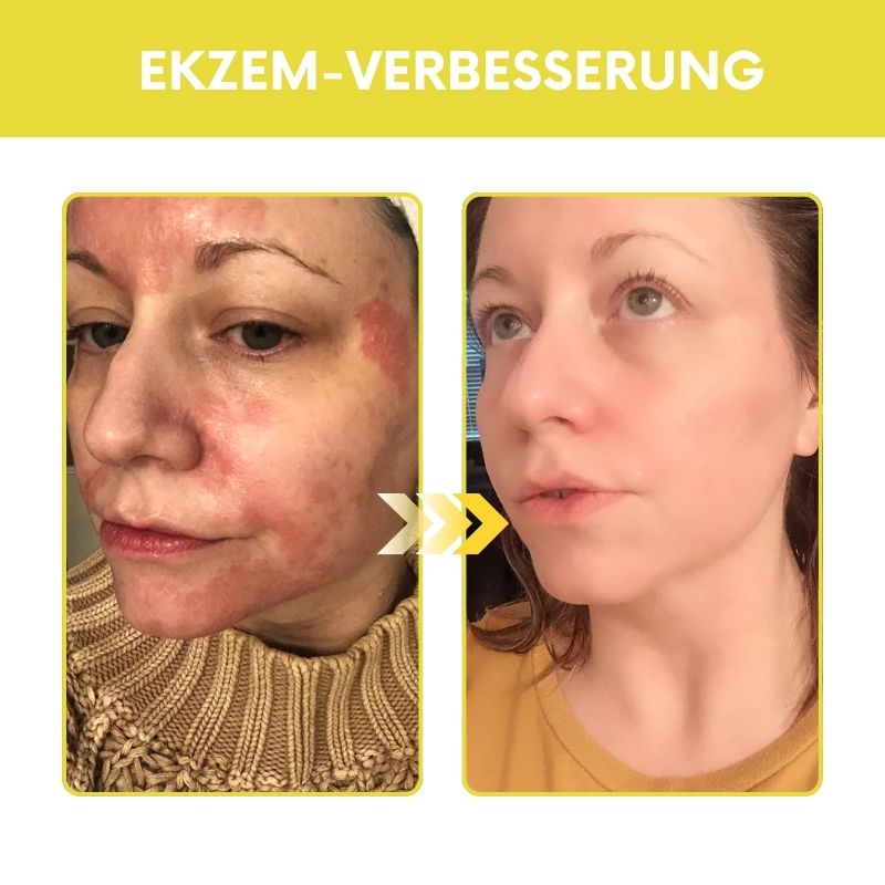 HerbaKur™ | Ekzem & Psoriasis Kräutercreme