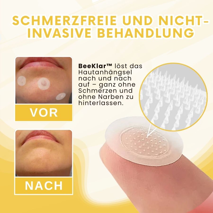 BeeKlar™ | Bienengift Hautanhängsel-Entferner Pflaster