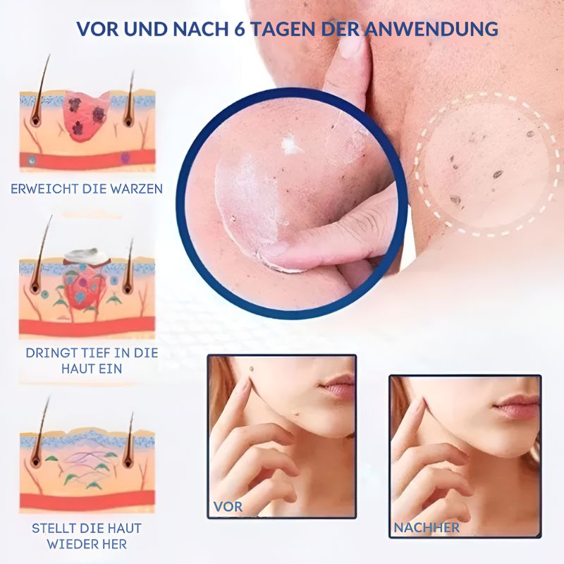 WartsOff™ | Entfernt Warzen sofort – schmerzlos