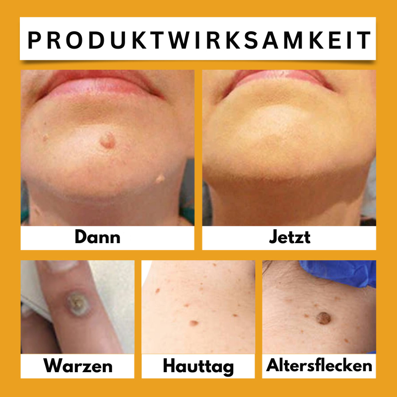HautKlar™ | Beseitigen Sie lästige Hautwarzen in nur 1-3 Wochen!