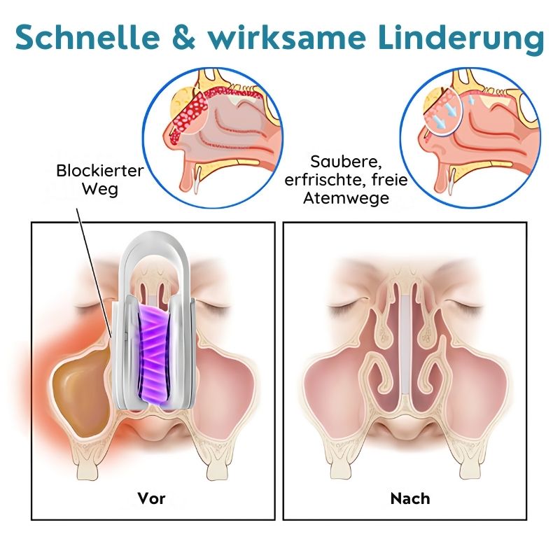 SchleimLöser™ | Nasenschleim-Reinigungsgerät