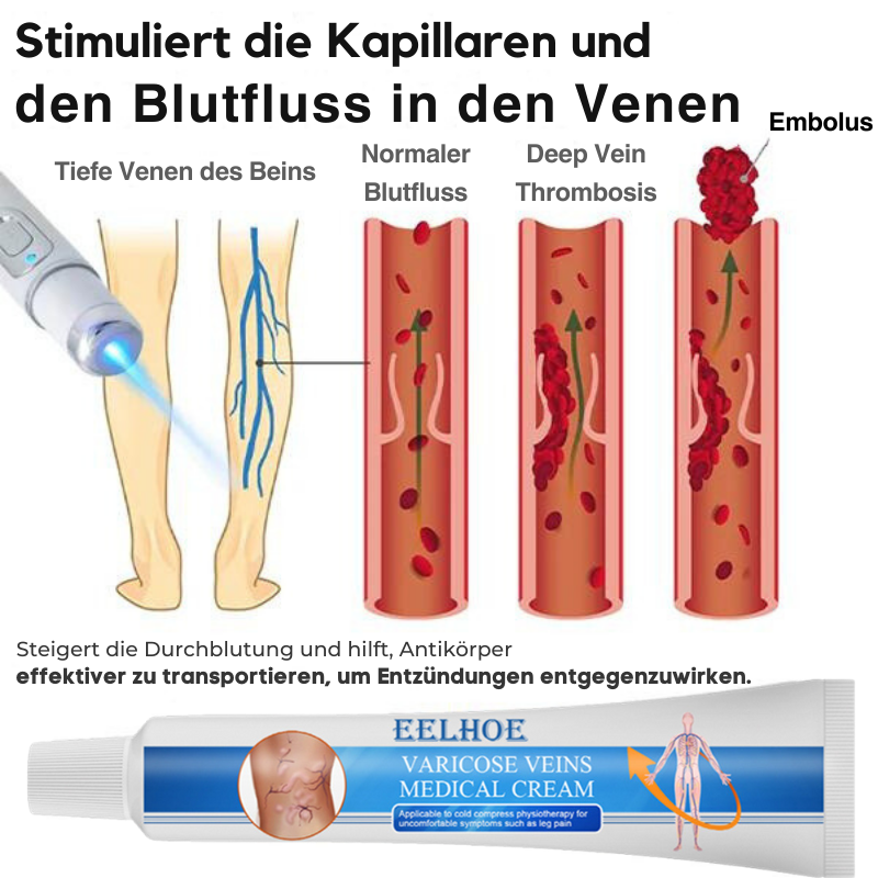 VaricoseKlar™ | Vollständige Beseitigung von Krampfadern in nur 4 Wochen!
