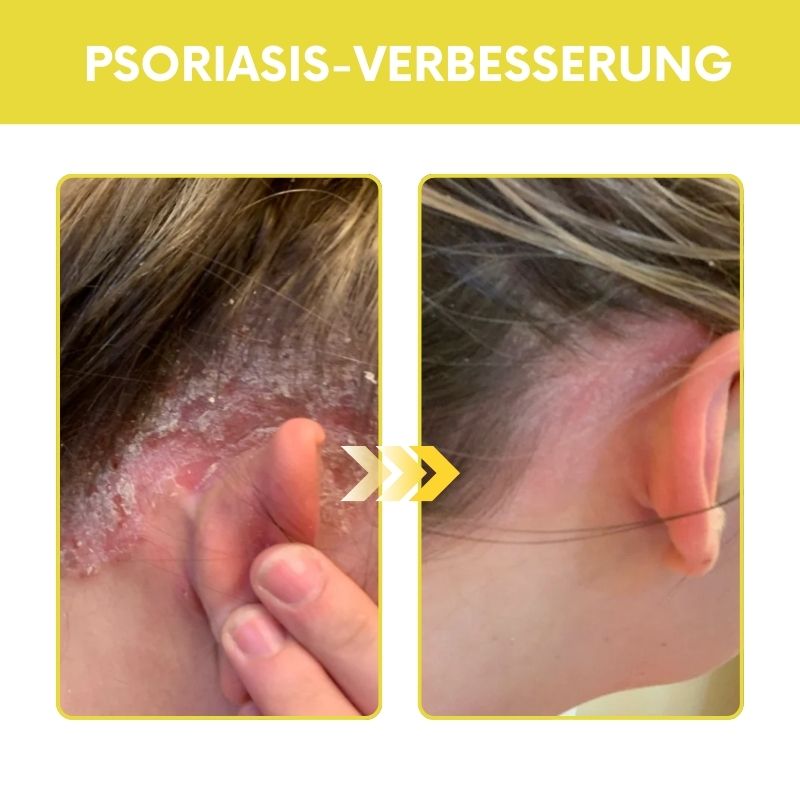 HerbaKur™ | Ekzem & Psoriasis Kräutercreme