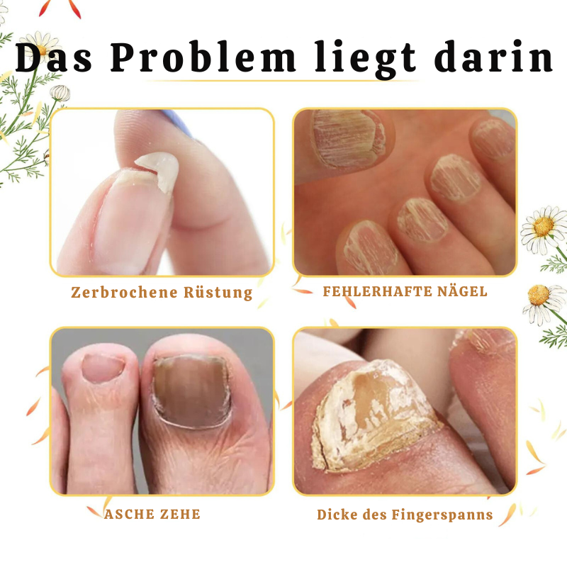 StarkNagel™ | Stärken Sie Ihre brüchigen Nägel in nur 1 Woche!