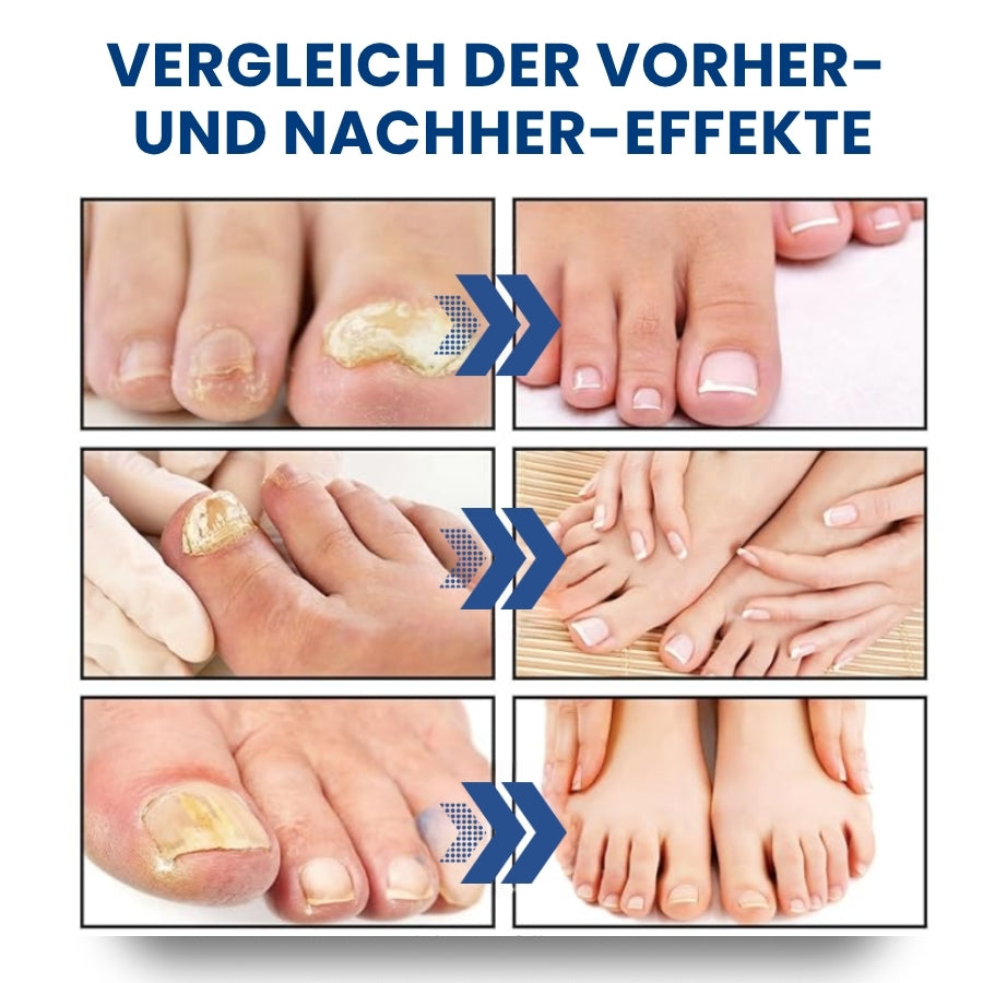 NailProtec™ | Nagelpilz Pflaster