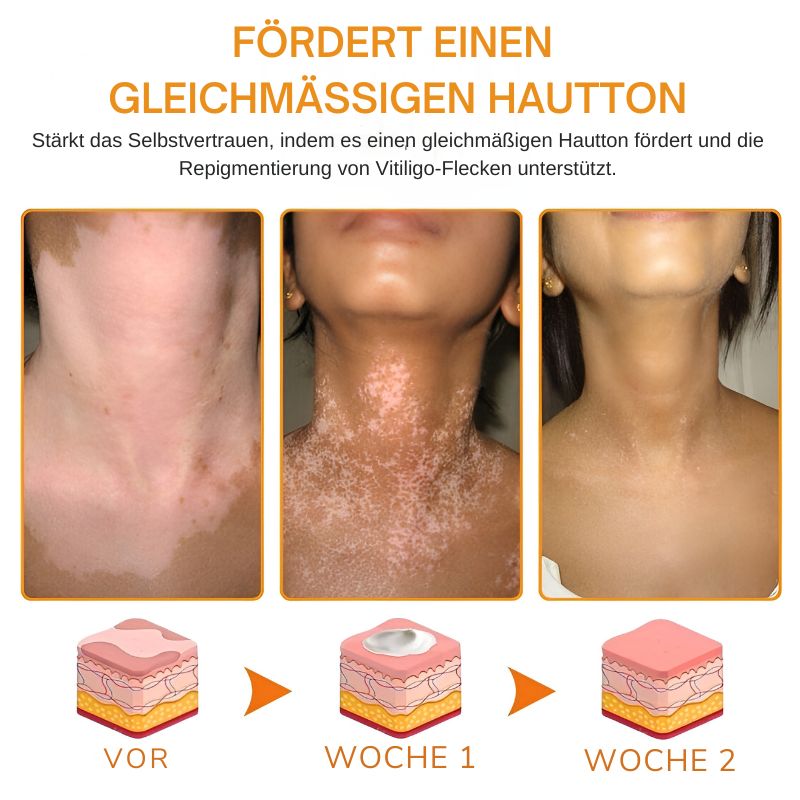 VitiligoCreme™ | Schlangengift Vitiligo Behandlungssalbe