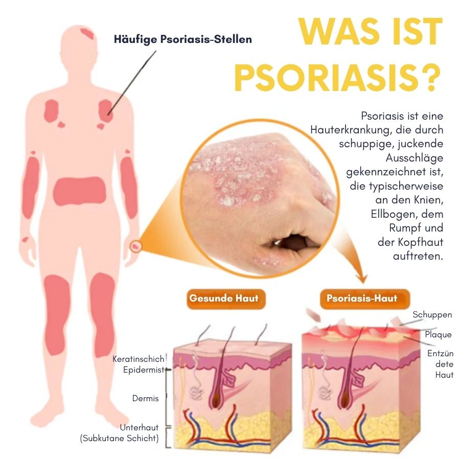 PsoriaFix™ | Bienenvenom Psoriasis Beruhigungsspray