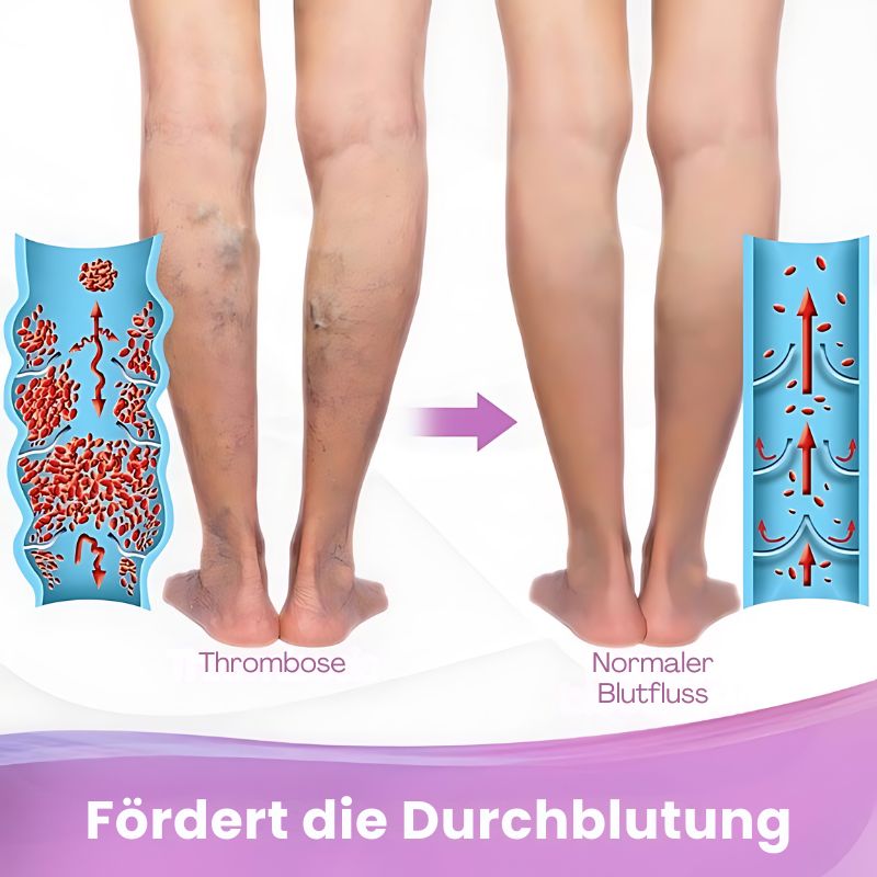 VaricoseKur™ | Krampfaderentfernung Creme