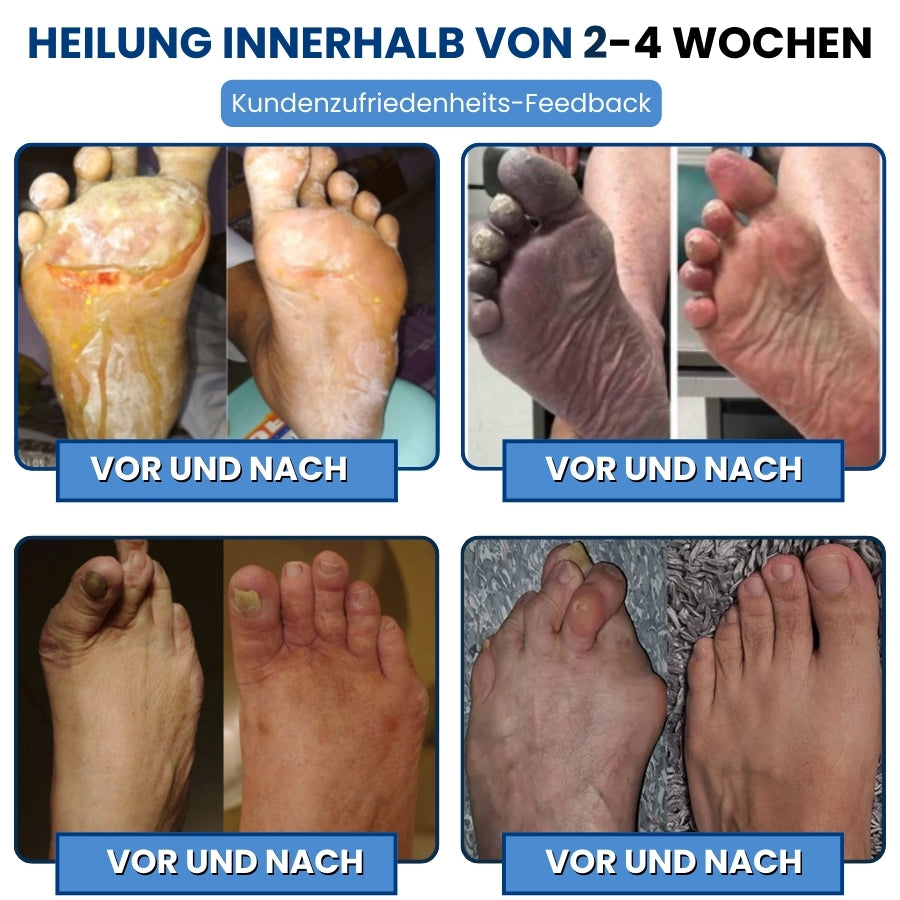 NeuroEase™ | Neuropathie Nerven Linderungscreme