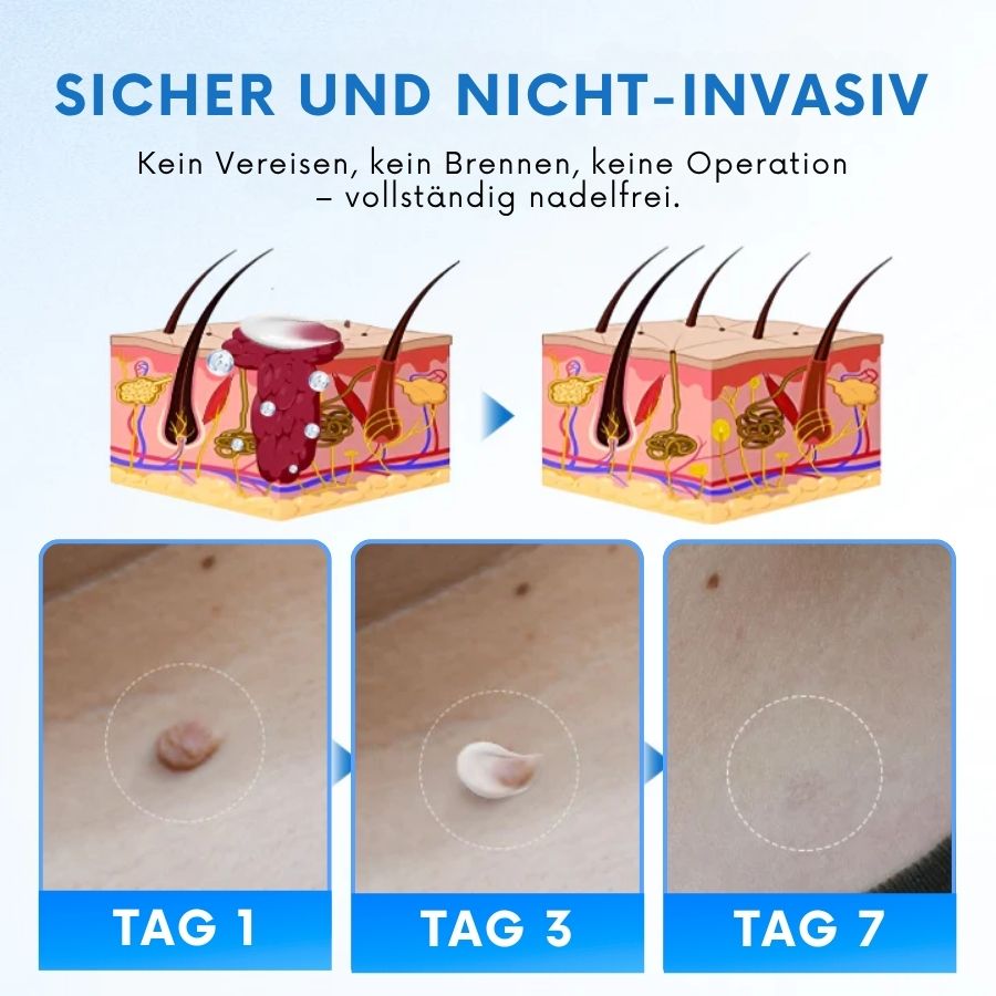 Tagiva™ | TagGone Warzenentfernungscreme
