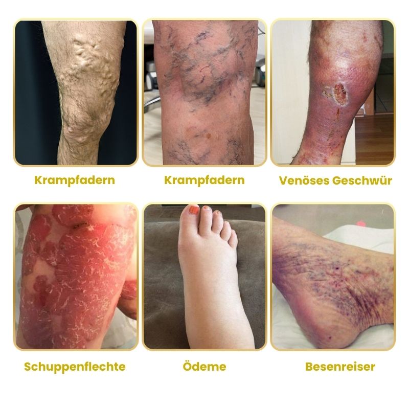 ArthroVeinSalbe™ | Creme zur Behandlung von Arthritis und Krampfadern