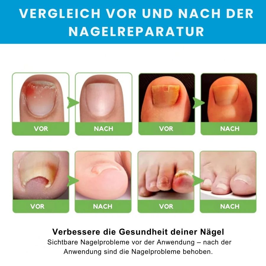 KlarNagel™  | Schnelle Antipilz-Salbe