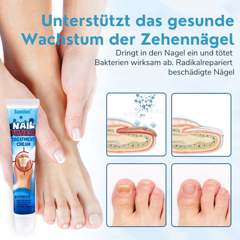 NagelHeil™ | Nagelpilz-Behandlungscreme