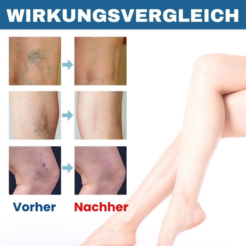 VenoKlar™ | Krampfadern- & Besenreiser-Creme
