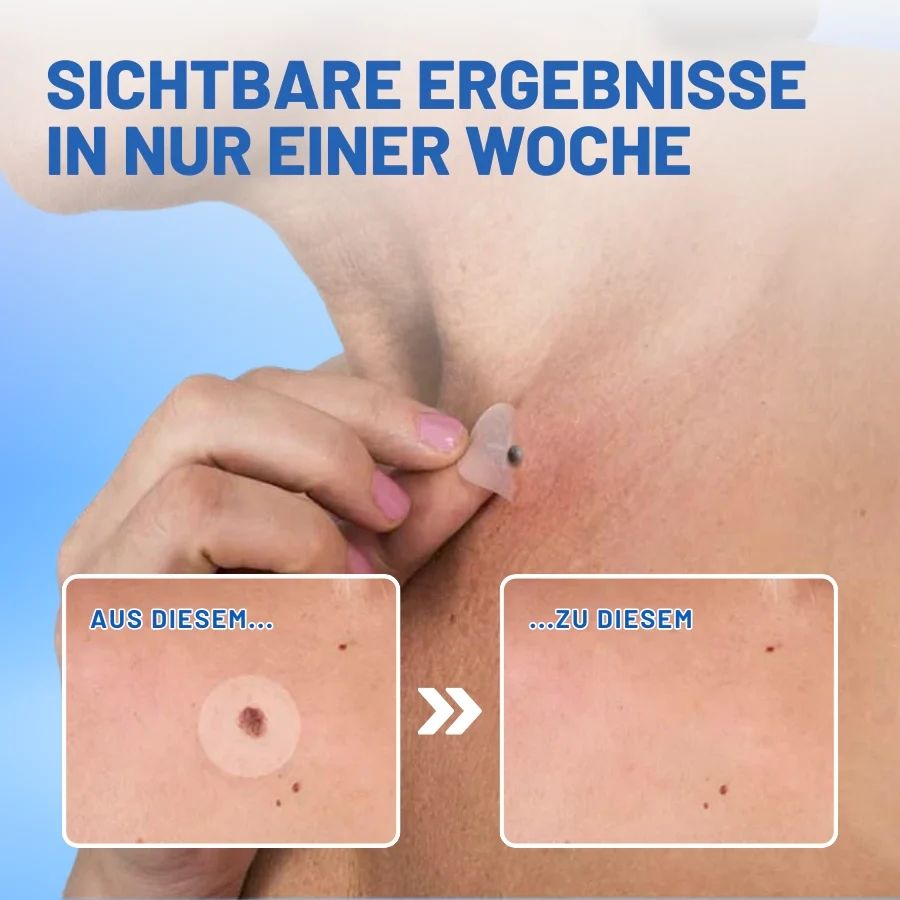 HautCure™ | Muttermal- & Warzenentfernung Hautanhängsel-Pflaster