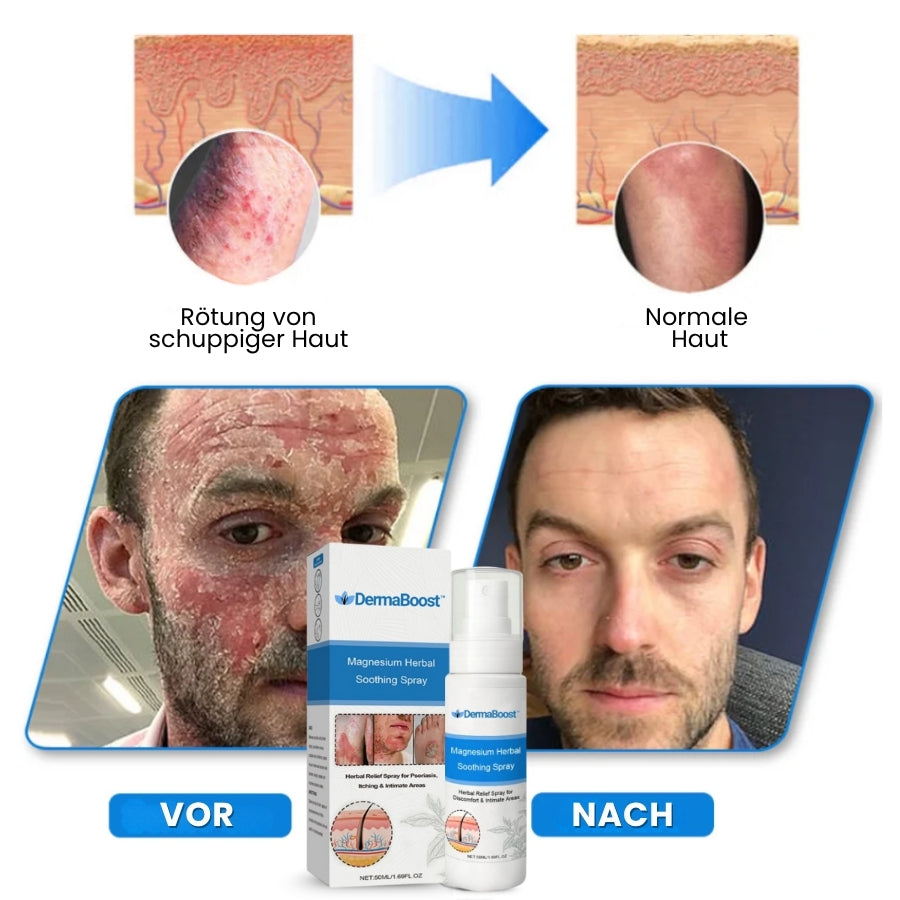 DermaBoost™ | Psoriasis und Ekzem Kräuter‑Beruhigungsspray