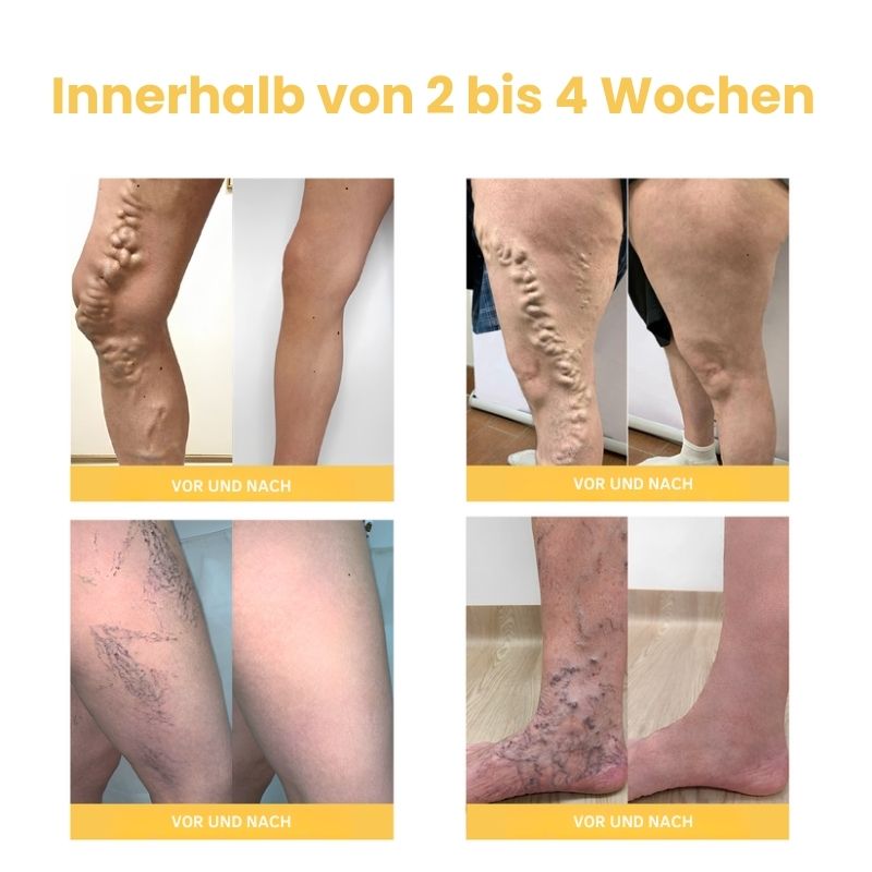 ArthroVeinSalbe™ | Creme zur Behandlung von Arthritis und Krampfadern