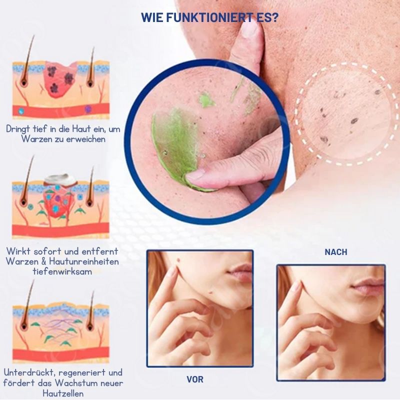 NatureErase™ | Creme gegen Hautunreinheiten