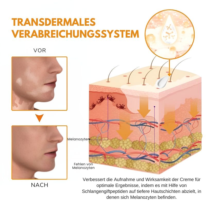 VitiligoCreme™ | Schlangengift Vitiligo Behandlungssalbe
