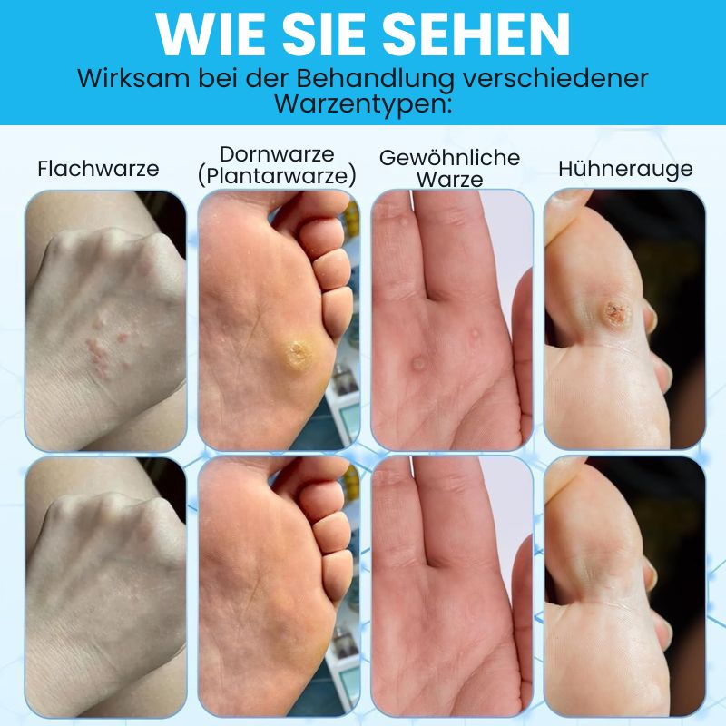 WartsOff™ | Entfernt Warzen sofort – schmerzlos